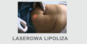 usuwanie tłuszczu lipotransfer lipoliza liposukcja