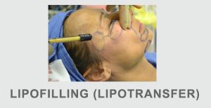 lipotransfer lipofilling przeszczep tłuszczu modelowanie własnym tłuszczem