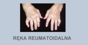 Ręka reumatoidalna