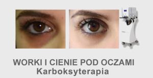Worki i cienie pod oczami karboksyterapia